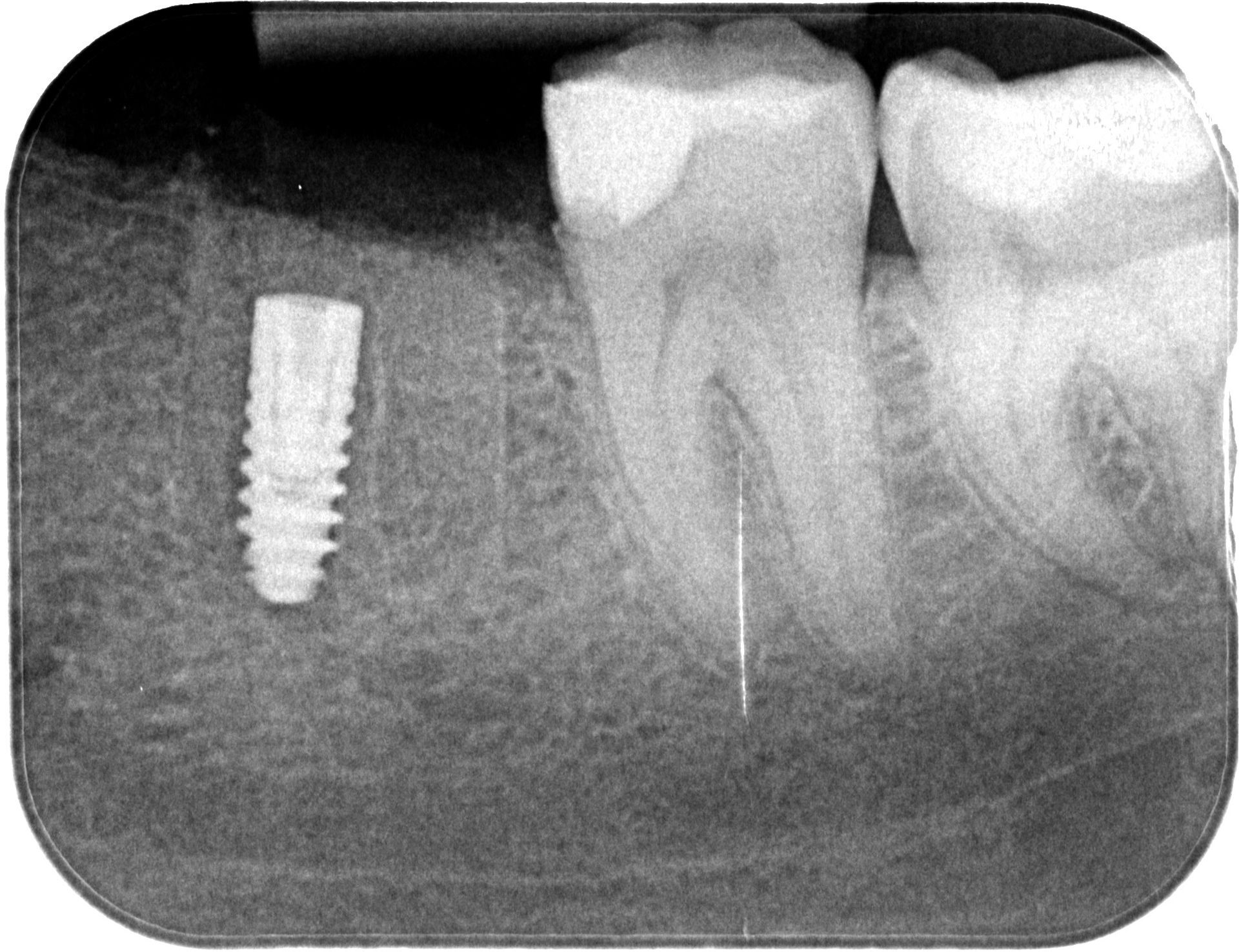 imediátna implantácia ihneď po extrakcii zuba