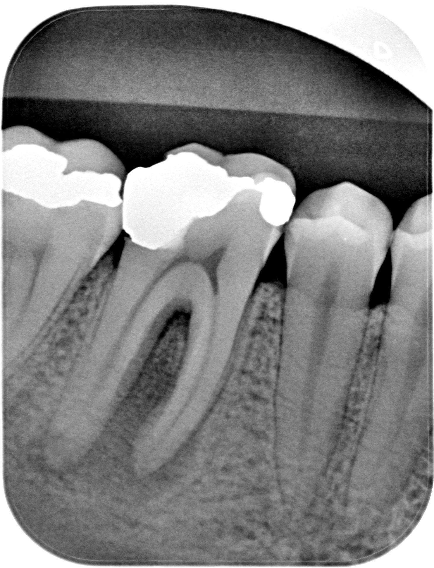 viditeľný chronický zápal v okolí koreňov zuba 46