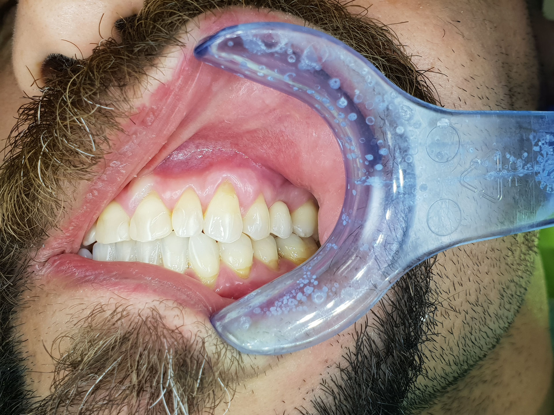 korunka nesená na implantáte v obl. zuba 25