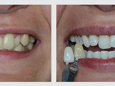 bielenie zubov systémom Pure Whitening