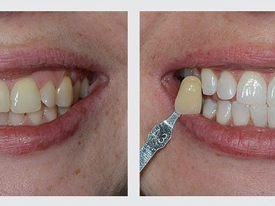 bielenie zubov systémom Pure Whitening
