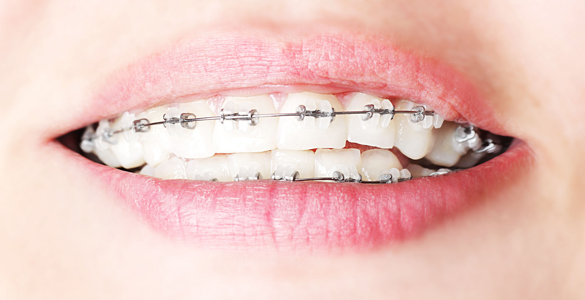 dental-braces-14.jpg